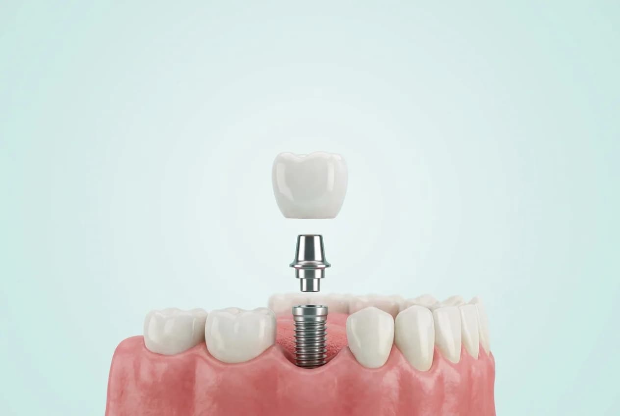 Cele trei piese ale unui implant complet: coroana, bontul protetic și implantul inserat în gingie