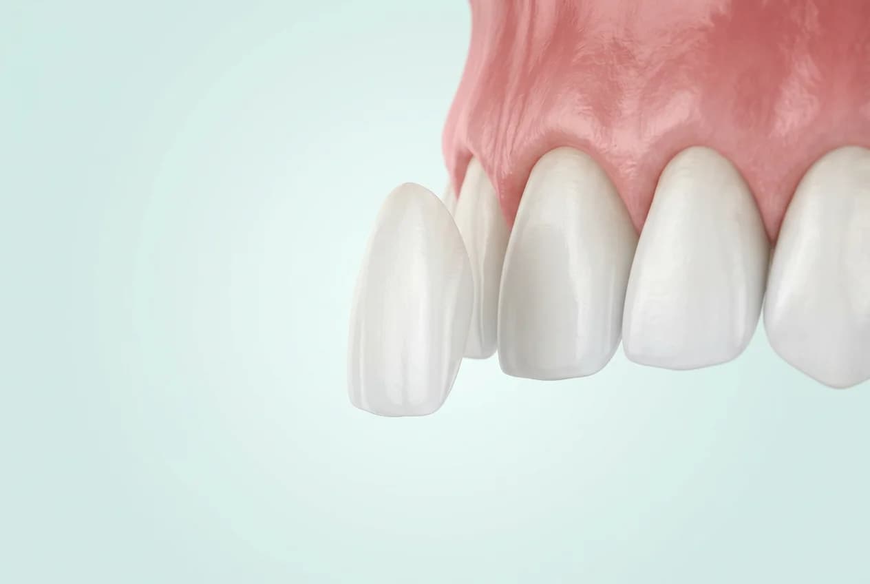 Fațetă dentară subțire din ceramică, poziționată în fața unui incisiv înainte de aplicare